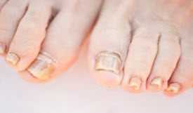 Onychomycosis - Fungal Nail Infection