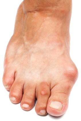 Painful bunion with irritated big toe joint