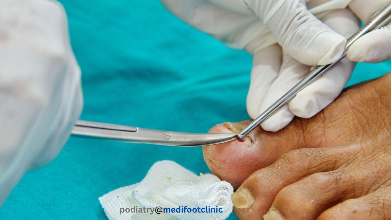 Podiatrist assessing a damaged toenail after injury