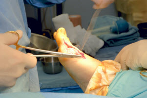 Bunion Surgery