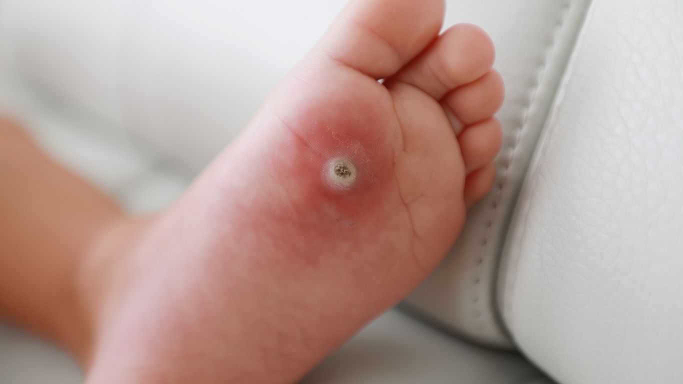 Child foot showing plantar wart