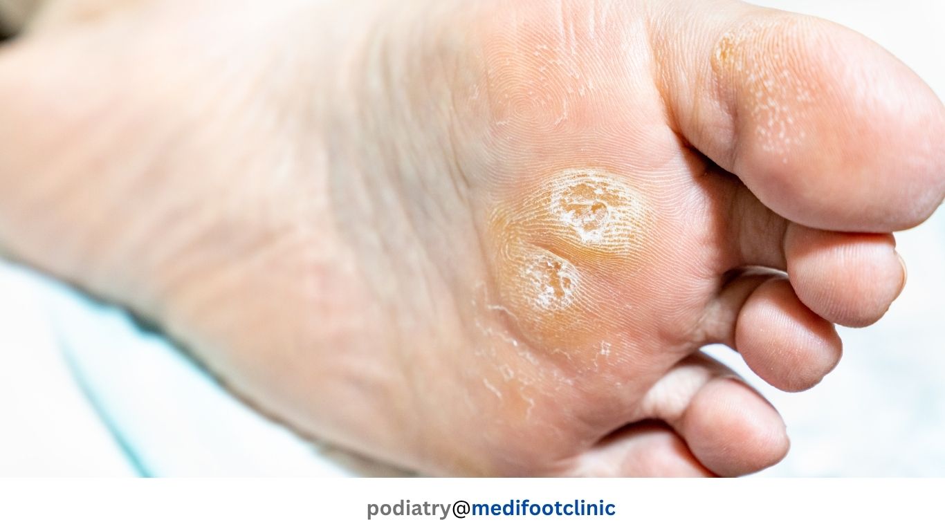 Foot with focal callus (illustrative)