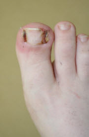 Ingrown Toenails In Children - 