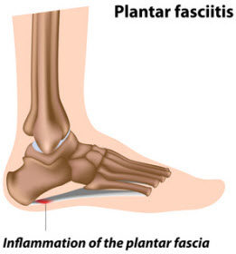 Plantar Fasciitis(Heel Pain)