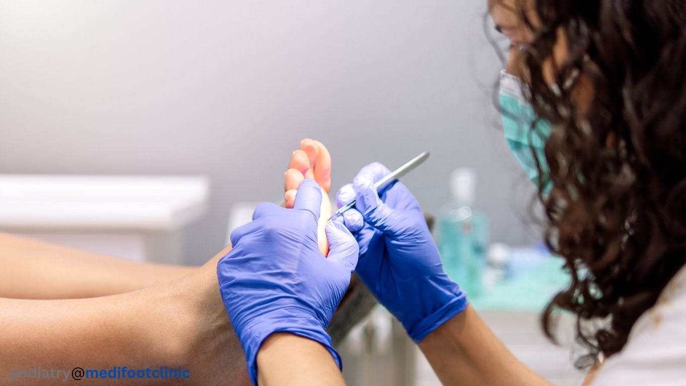 Podiatry care removing hard skin and corn